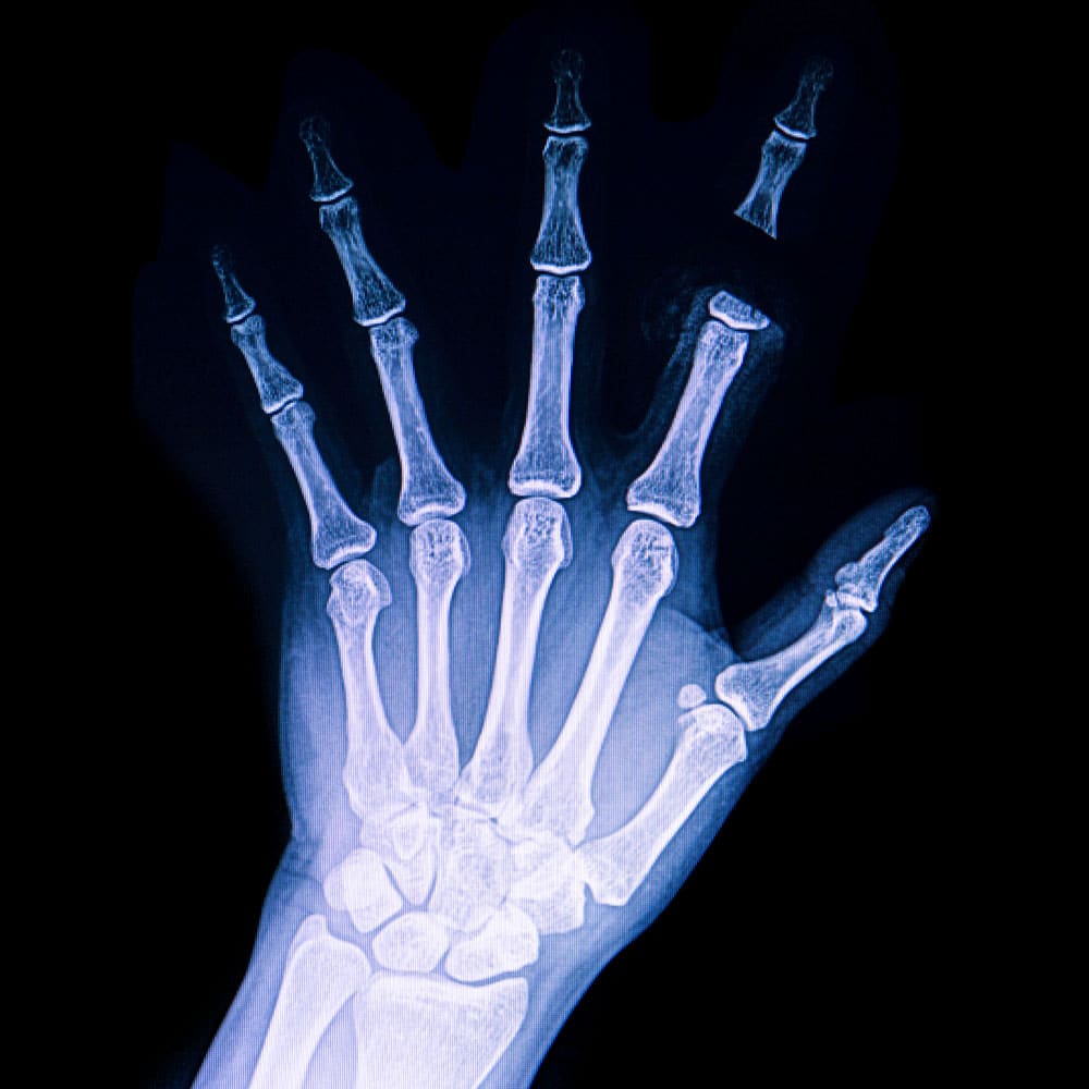 crush injury attorney houston