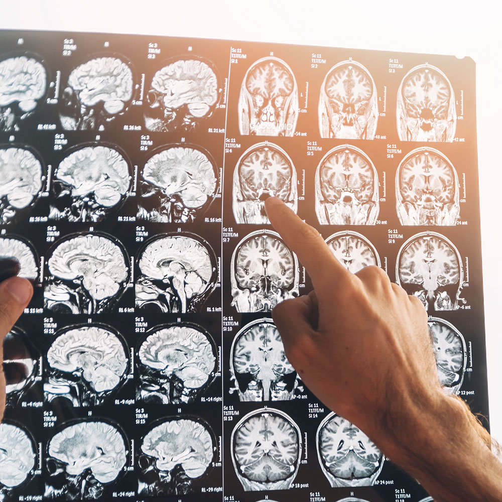traumatic brain injury lawyer houston