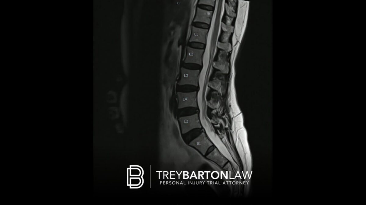 spinal cord injury lawyer houston